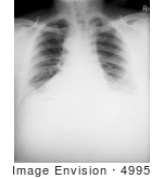 #4995 Stock Photography Of The Chest X-Ray Of A 46 Year Old Man Diagnosed With The Anthrax Disease