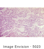 #5023 Photomicrograph Of Lung Tissue Infected With Bacillus Anthracis Bacteria