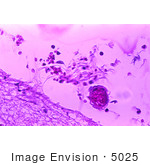 #5025 Stock Photography Of Mild Meningitis With Hemorrhage Due To Bacillus Anthracis