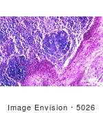 #5026 Stock Photography Of Hemorrhagic Lymph Node Due To Inhalation Anthrax