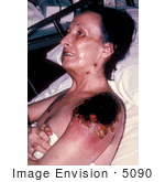 #5090 Stock Photography Of A Female Patient With Vaccinia Gangrenosum