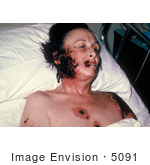 #5091 Stock Photography Of A Woman With Progressive Vaccinia Gangrenosum