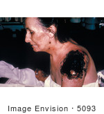 #5093 Stock Photography Of An Ill Patient With Life Threatening Progressive Vaccinia Gangrenosum