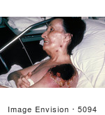 #5094 Stock Photo Of Progressive Vaccinia Gangrenosum On The Shoulder Of A Woman