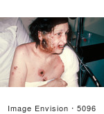 #5096 Picture Of A Woman Showing Severe Complications Of A Smallpox Vaccination
