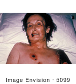 #5099 Stock Photography Of A Female Patient With Progressive Vaccinia From A Smallpox Vaccination