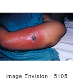 #5105 Stock Photography Of A Female Patient Presented With Vaccinia Gangrenosum 1 Month After A Smallpox Vaccination