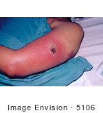#5106 Stock Photography Of A Patient With Vaccinia Gangrenosum 1 Month After A Smallpox Vaccination