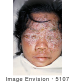 #5107 Stock Photography Of A 28 Year Old Woman With Eczema Vaccinatum
