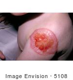 #5108 Picture Of A Patient With Progressive Vaccinia On His Shoulder