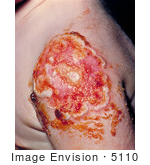 #5110 Picture Of A Child With Progressive Vaccinia On His Arm