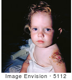 #5112 Picture Of A Kid With Progressive Vaccinia On His Arm