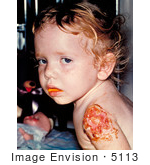 #5113 Stock Photo Of A Boy With Progressive Vaccinia