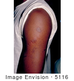#5116 Picture Of A Person With Secondary Herpes Infection On His Arm