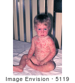 #5119 Stock Photography Of A Child That Developed A Severe Rash From A Smallpox Vaccine