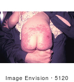 #5120 Stock Photography Of A Child That Had An Allergic Reaction To A Smallpox Vaccination