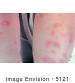 #5121 Stock Photography Of Erythema Multiforme On The Legs Of A Child