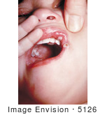 #5126 Stock Photography Of A Child With Autoinoculation