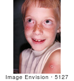 #5127 Stock Photography Of A Child With A Case Of Autoinoculation Of Her Cheek After Being Vaccinated With Vaccinia