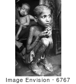 #6767 Picture of a Kid with Smallpox Disease by KAPD