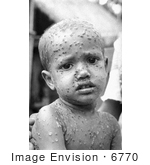 #6770 Picture Of A Child Infected With The Smallpox Disease