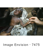 #7475 Picture Of A Nigerian Child Suffering From Smallpox During The Biafran War
