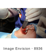 #8936 Picture Of A Tooth Extraction