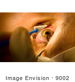#9002 Picture Of Lasik Surgery