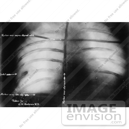 #27638 Stock Photo of an Xray Of The Bullet Inside President Theodore Roosevelt After John Schrank Shot Him On October 14th 1912 by JVPD