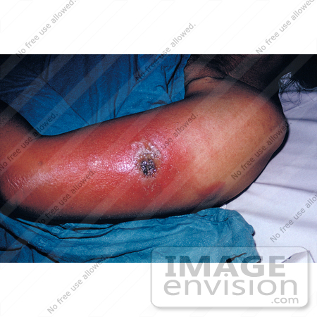 #5105 Stock Photography of a Female Patient Presented with Vaccinia Gangrenosum 1 Month After a Smallpox Vaccination by JVPD