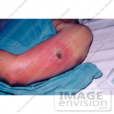 #5106 Stock Photography of a Patient with Vaccinia Gangrenosum 1 Month after a Smallpox Vaccination by JVPD