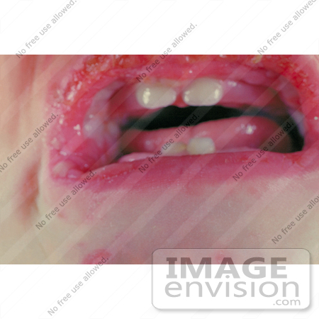 #5122 Stock Photography of a Child with the Stevens-Johnson Syndrome by JVPD