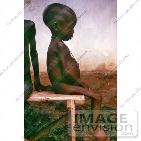 #6769 Picture of a Child with Kwashiorkor Disease from Severe Dietary Protein Deficiency by KAPD