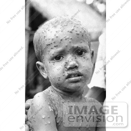 #6770 Picture of a Child Infected with the Smallpox Disease by KAPD