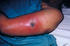 #5105 Stock Photography of a Female Patient Presented with Vaccinia Gangrenosum 1 Month After a Smallpox Vaccination by JVPD