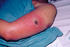 #5106 Stock Photography of a Patient with Vaccinia Gangrenosum 1 Month after a Smallpox Vaccination by JVPD