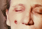 Woman with an Anthrax Skin Lesion on the 5th Day
