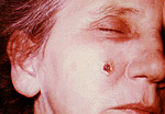 Woman with an Anthrax Skin Lesion on the 8th Day