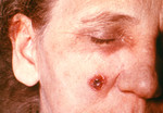 Woman with an Anthrax Skin Lesion on the 11th Day