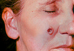 Woman with an Anthrax Skin Lesion on the 6th Day