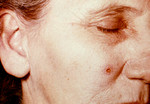 Woman with an Anthrax Skin Lesion on the 4th Day