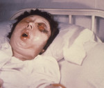 Woman On the 5th Day of an Anthrax Infection Involving Her Eye