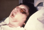 Patient On the 5th Day of an Anthrax Infection In Her Eye