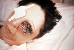 Patient On the 25th Day of an Anthrax Infection Involving Her Eye