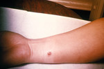 4th Day of an Anthrax Lesion on a Woman