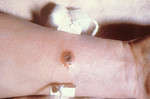 Cutaneous Anthrax Lesion