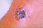 Forearm Anthrax Lesion Which Has Begun to Turn Black