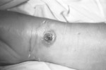 Patients Arm with Cutaneous Anthrax Lesion