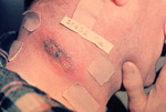 Cutaneous Anthrax Lesion on the Neck of a Man