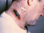 Man with a Cutaneous Anthrax Lesion On His Neck